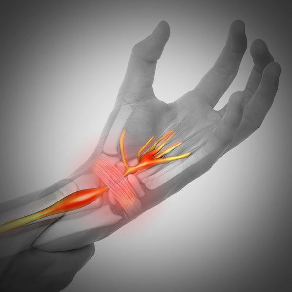 Carpal Tunnel Syndrome