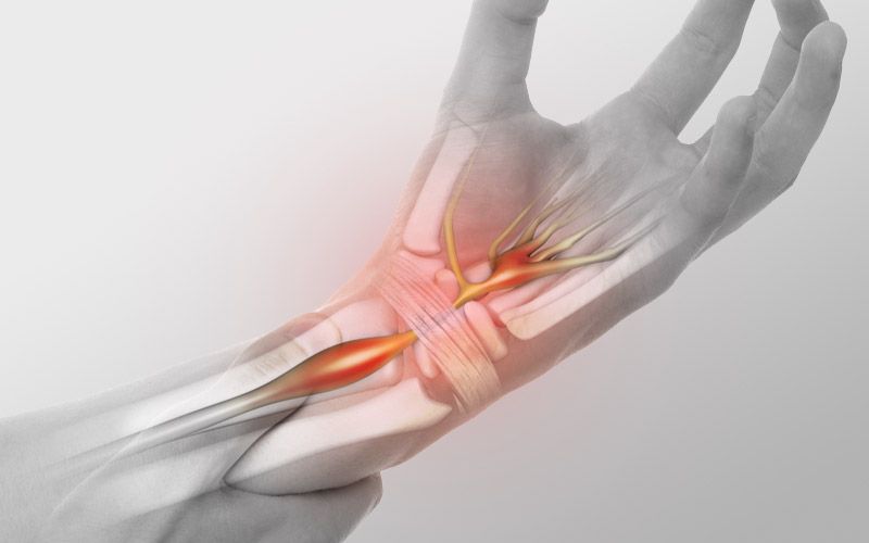 Diagram showing inflamed carpal tunnel
