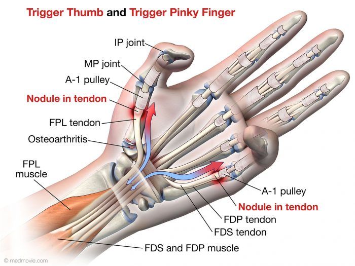 An internal view of trigger finger.