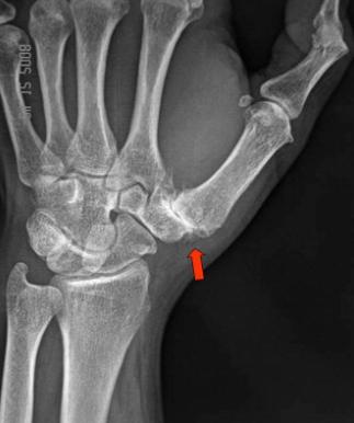 Hand X-ray