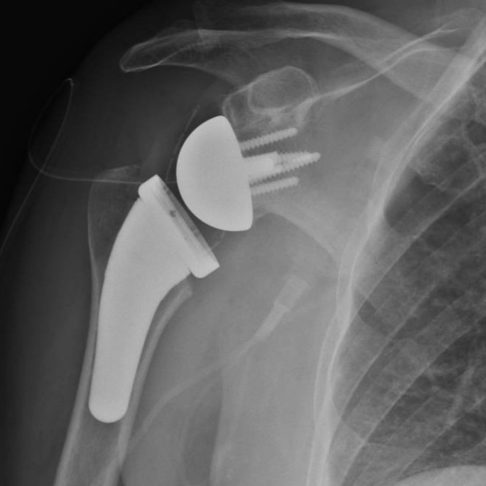 Shoulder replacement X-ray