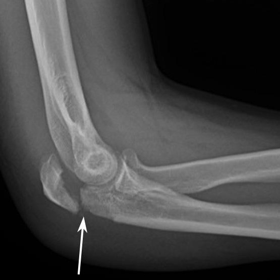 Elbow injury X-ray