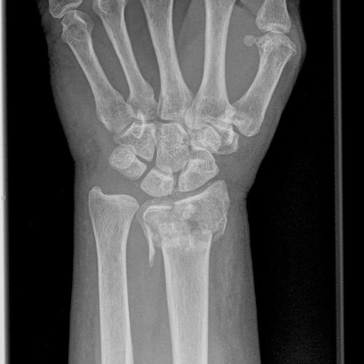 Wrist X-ray