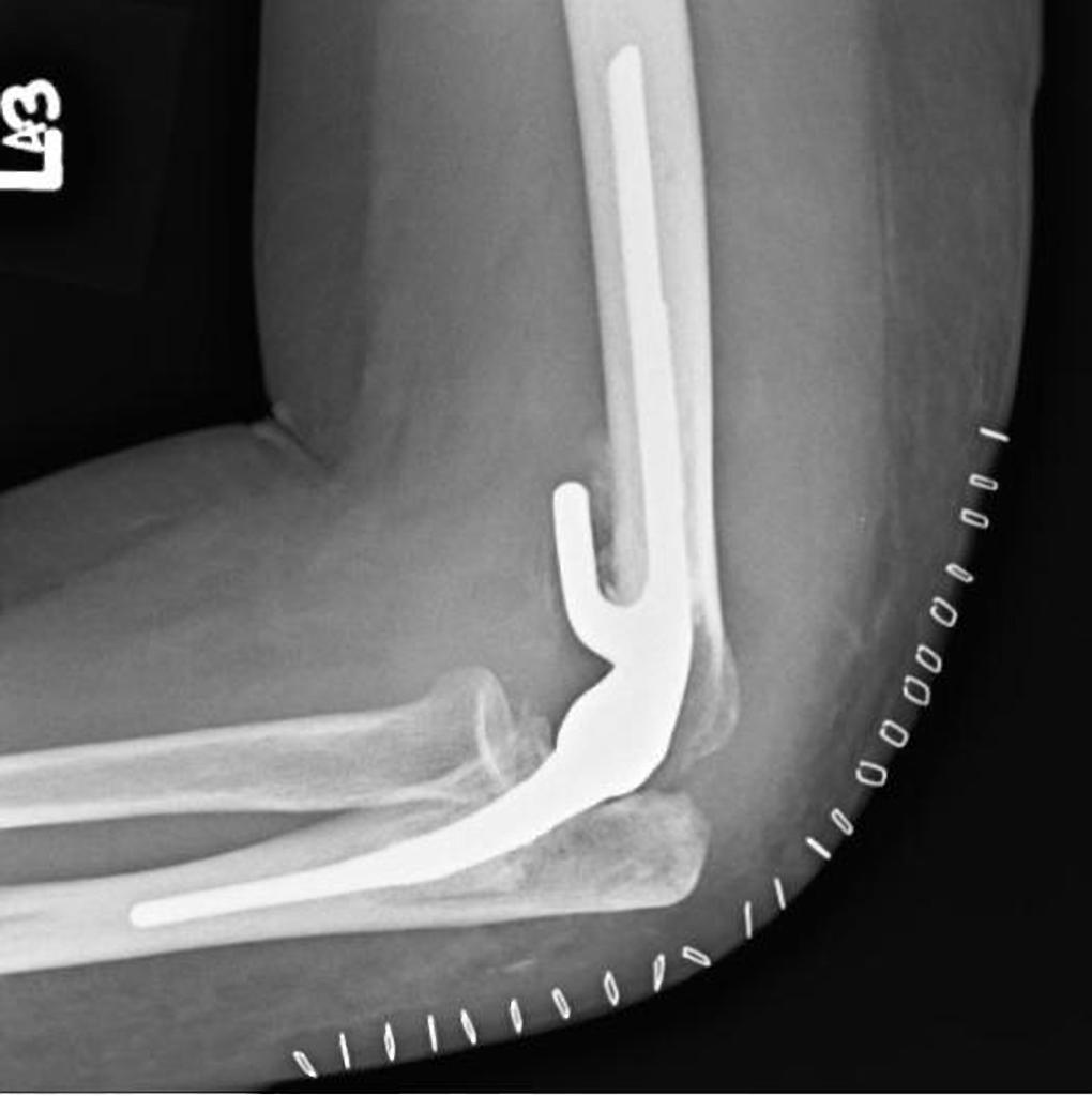 Elbow replacement X-ray
