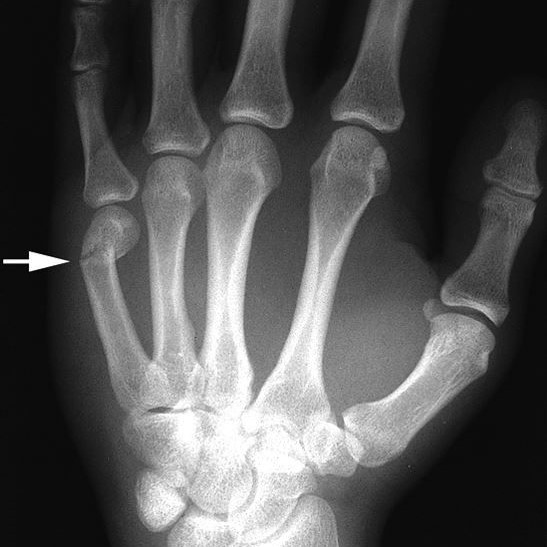 Finger injury X-ray