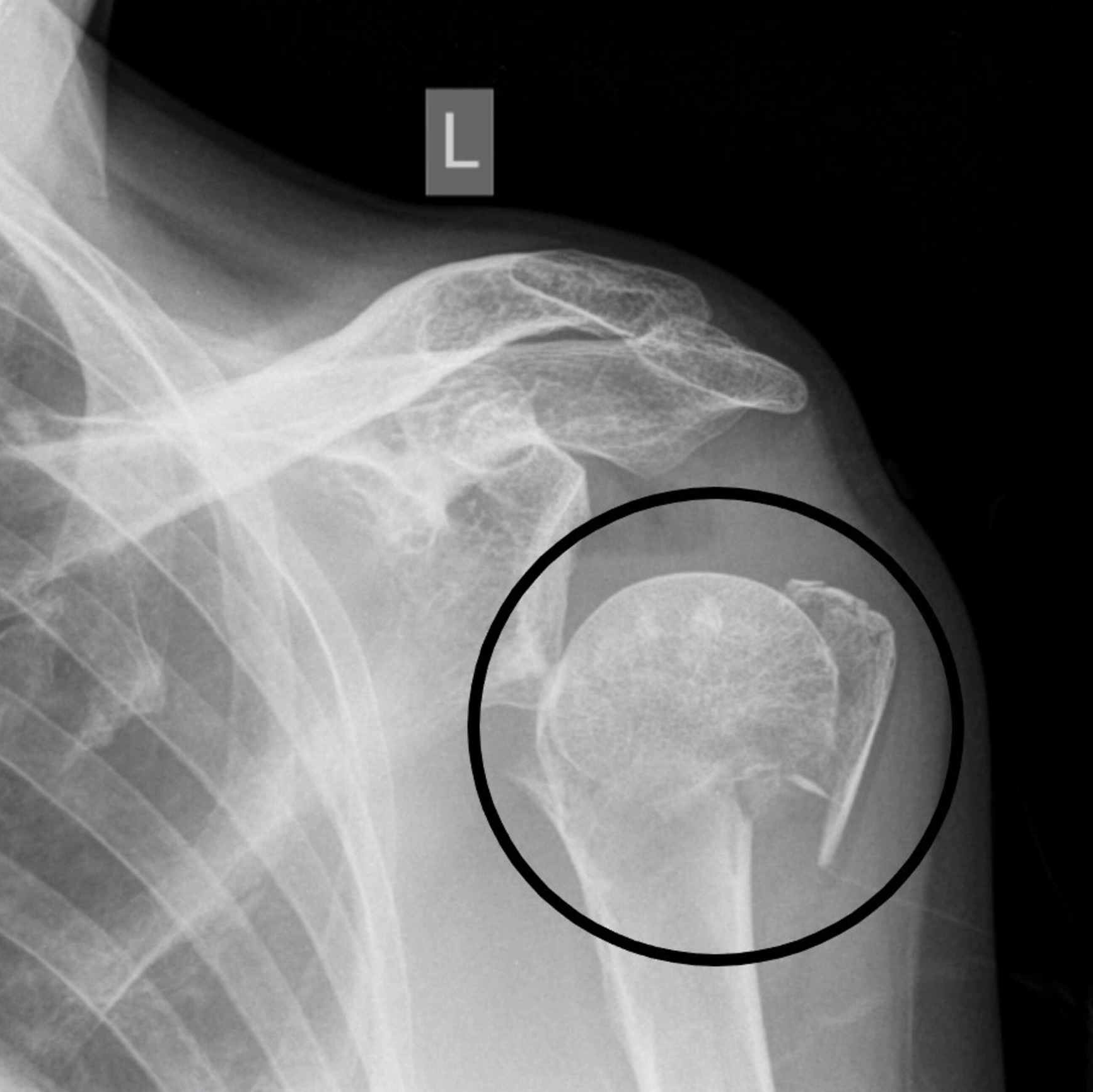 Shoulder injury X-ray