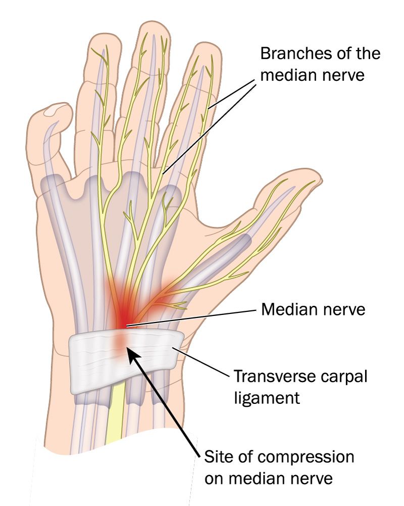 Carpal tunnel syndrome diagram
